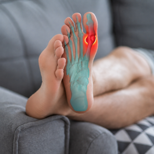la foto mostra due piedi di cui di uno è mostrata lo scheletro e l'alluce arrossato.